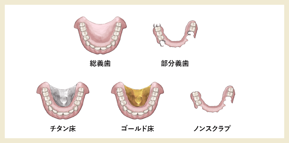 5種類の入れ歯（総義歯、部分義歯、チタン床、ゴールド床、ノンスクラプ）